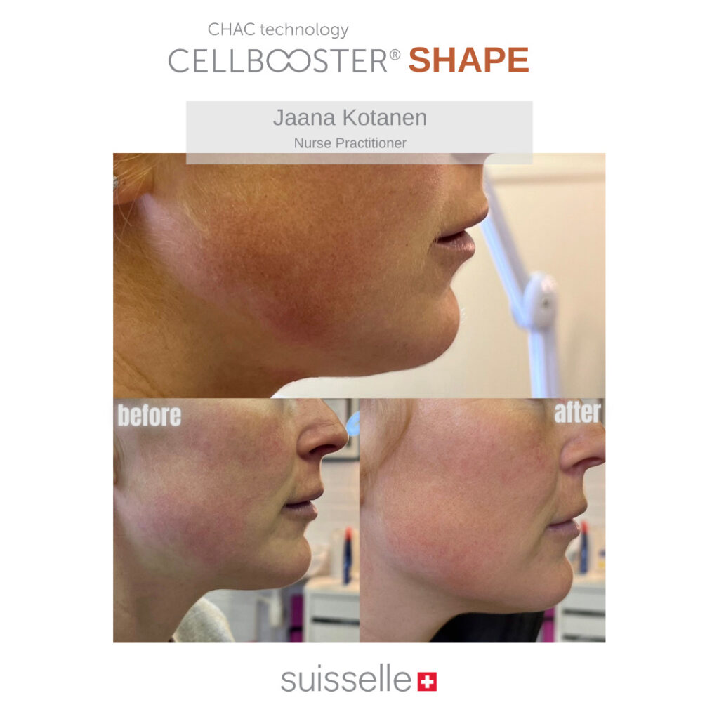 Penumpukan Lemak di Wajah