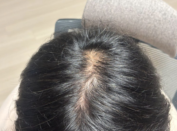 perawatan untuk rambut rontok
