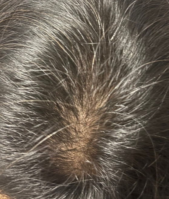 perawatan untuk rambut rontok