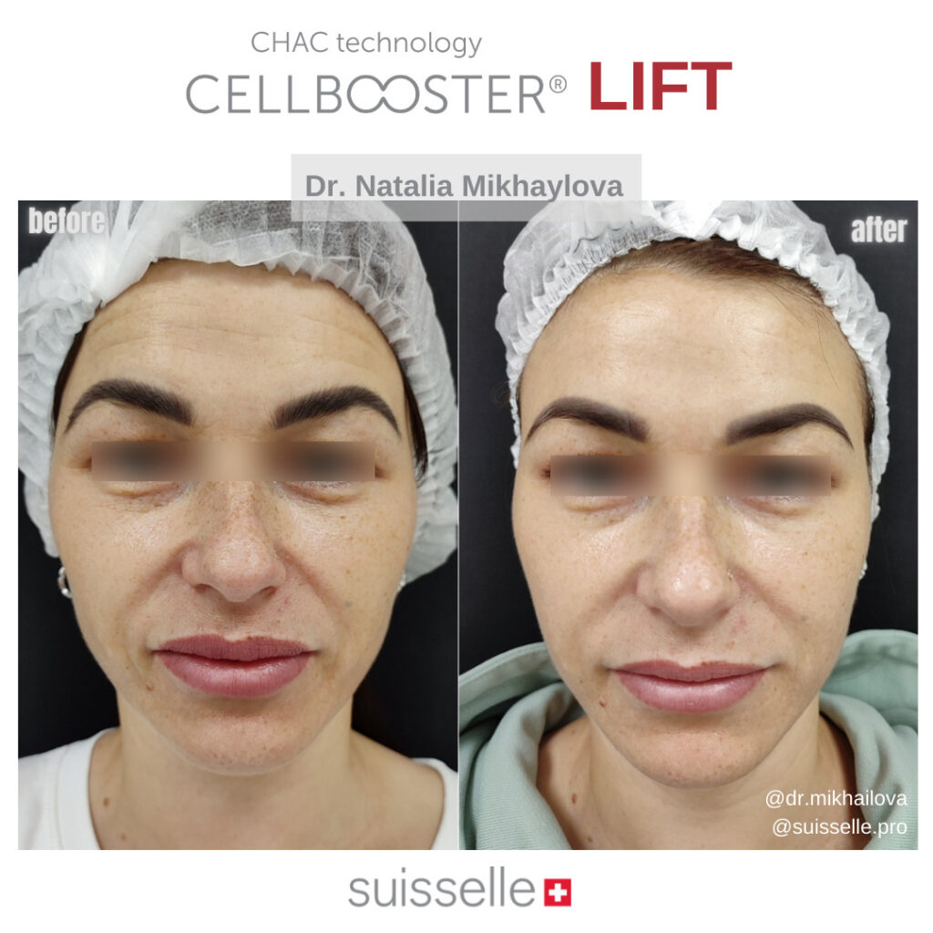 Garis-garis Halus pada Wajah