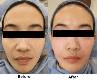 Pipi Cekung