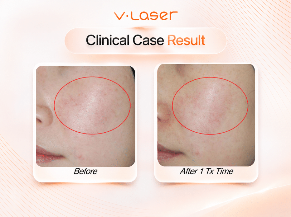 Telangiectasia Wajah