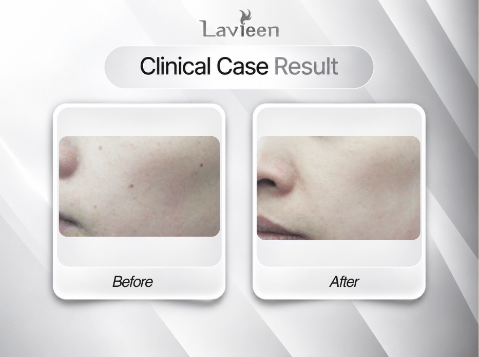 treatment melasma