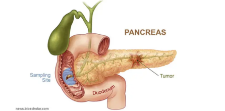 Kanker Pankreas