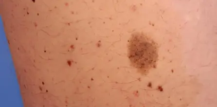 Perbedaan Antara Nevus dan Melanoma