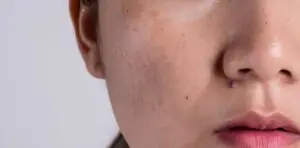 Mengatasi Melasma