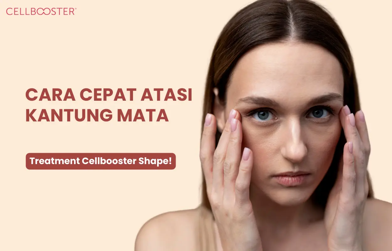 Mengatasi Kantung Mata