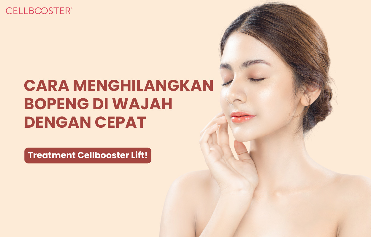 Cara Menghilangkan Bekas Jerawat