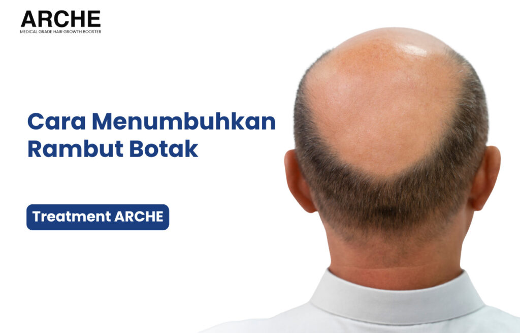 Cara Menumbuhkan Rambut Botak