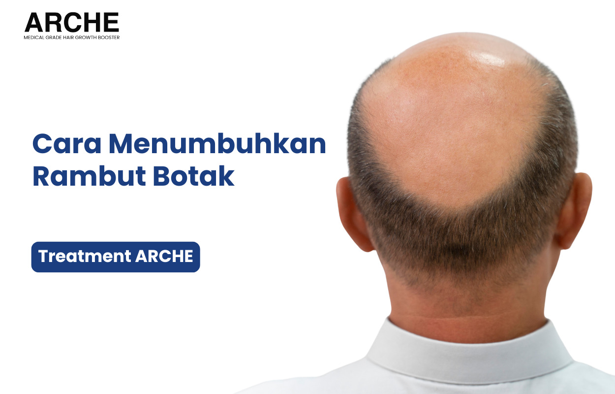 Cara Menumbuhkan Rambut Botak