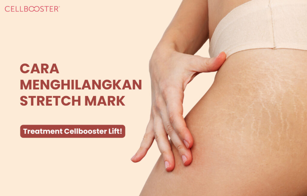 Menghilangkan Stretch Mark