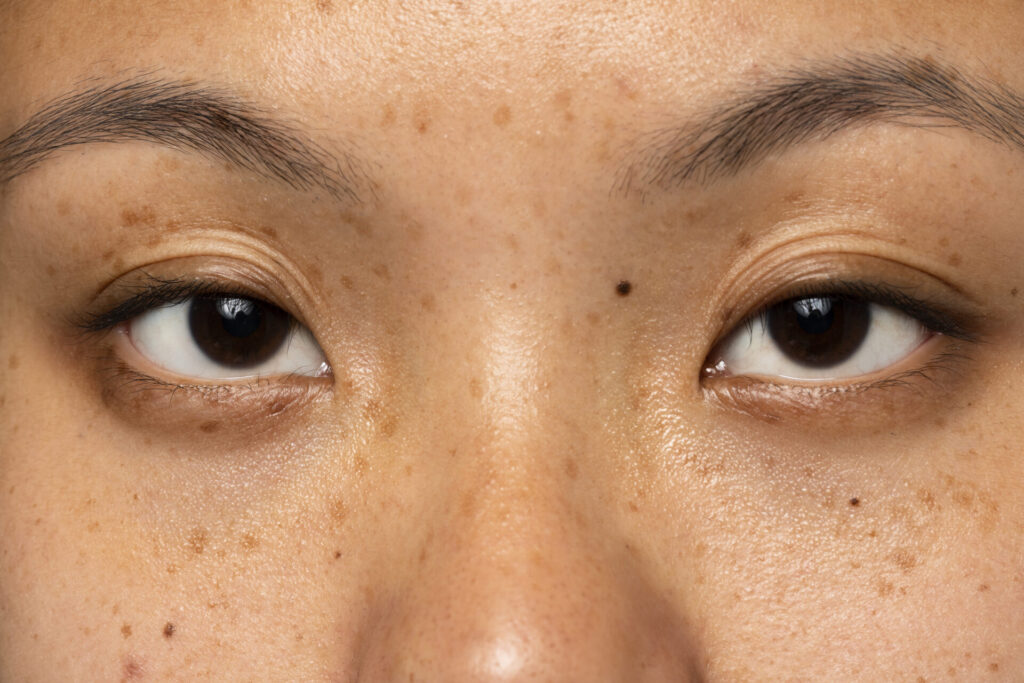 Cara menghilangkan freckles