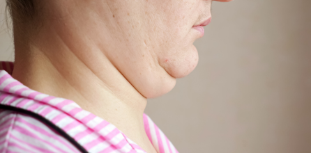 Cara menghilangkan double chin