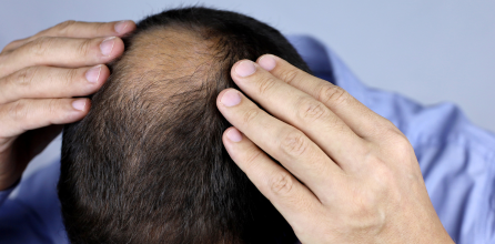 alopecia areata