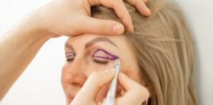 blepharoplasty