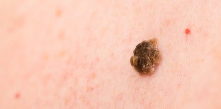 Keratosis Seboroik