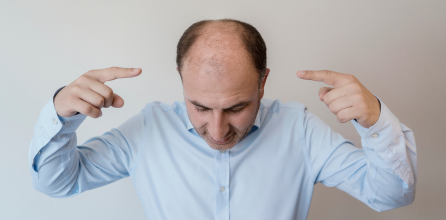 cara menumbuhkan rambut botak di jidat