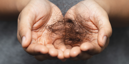 Apa yang menyebabkan rambut rontok