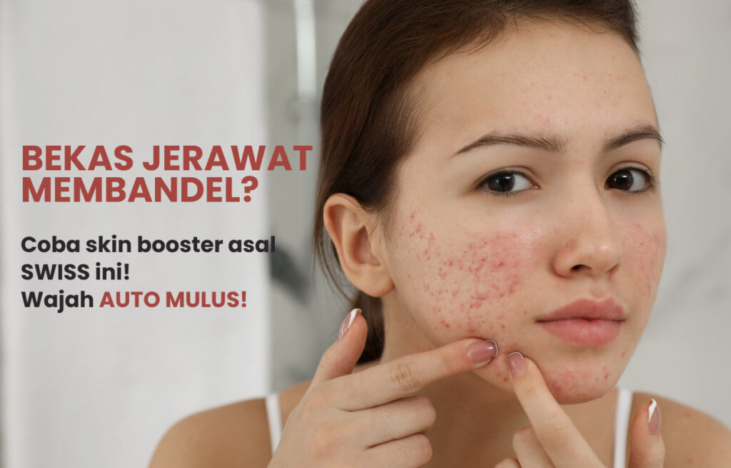 Skincare untuk menghilangkan bekas jerawat