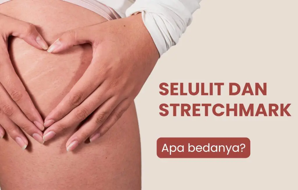 Perbedaan selulit dan stretchmark