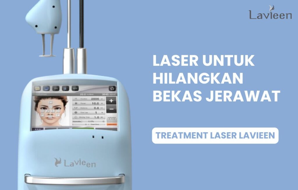 Laser menghilangkan bekas jerawat