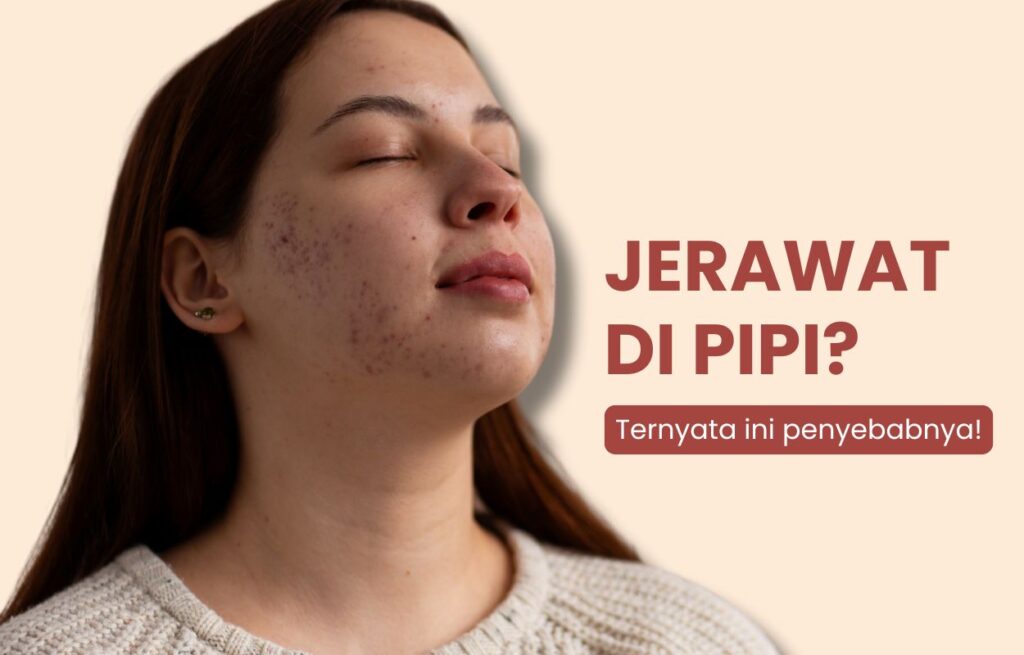 Jerawat di Pipi