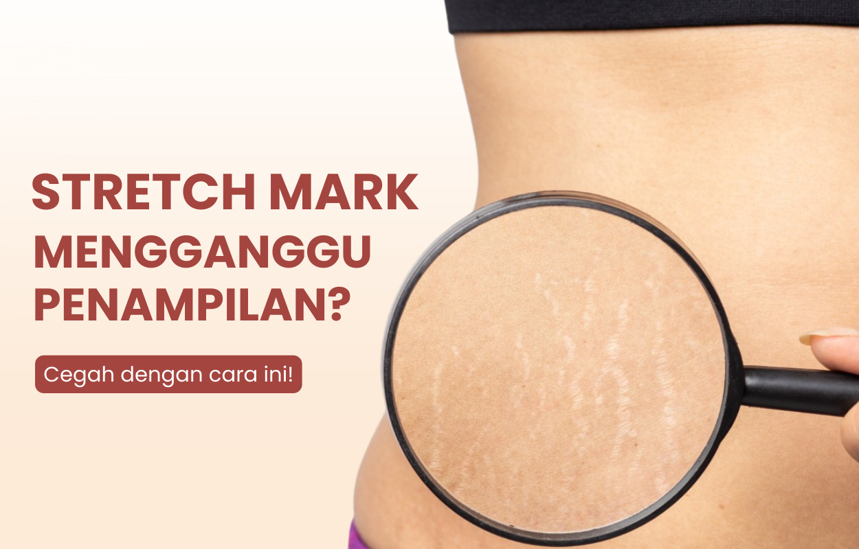 cara mencegah stretch mark