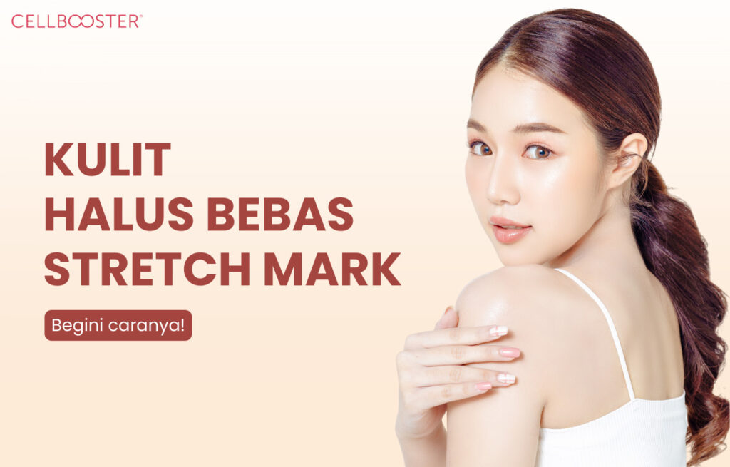 Stretch Mark adalah