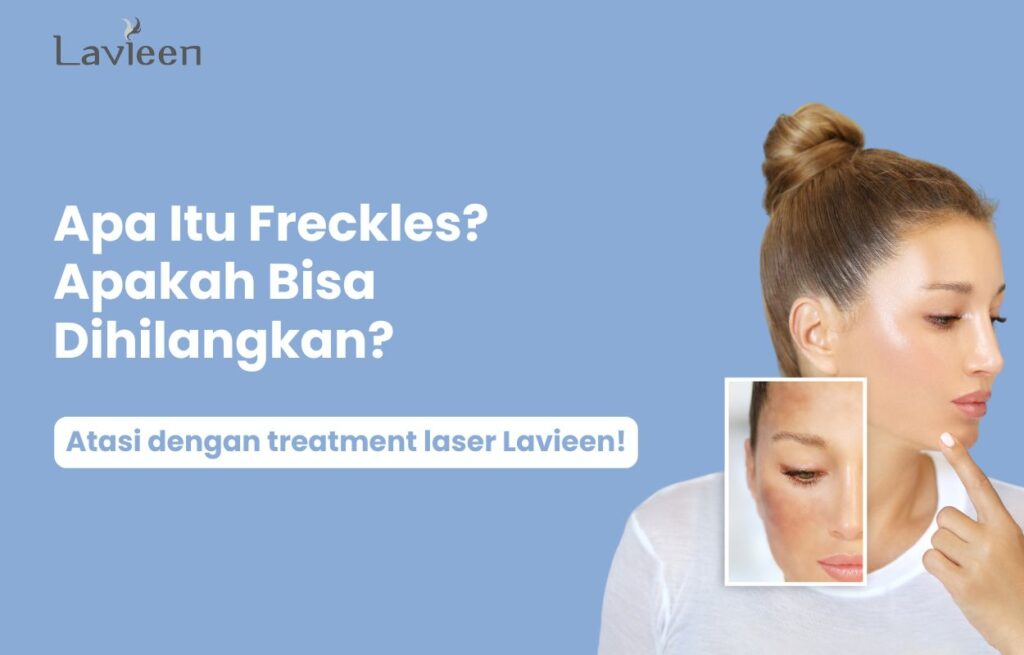 freckles artinya