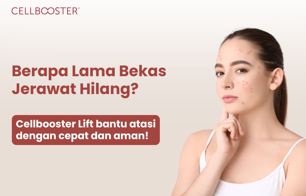 berapa lama bekas jerawat hilang