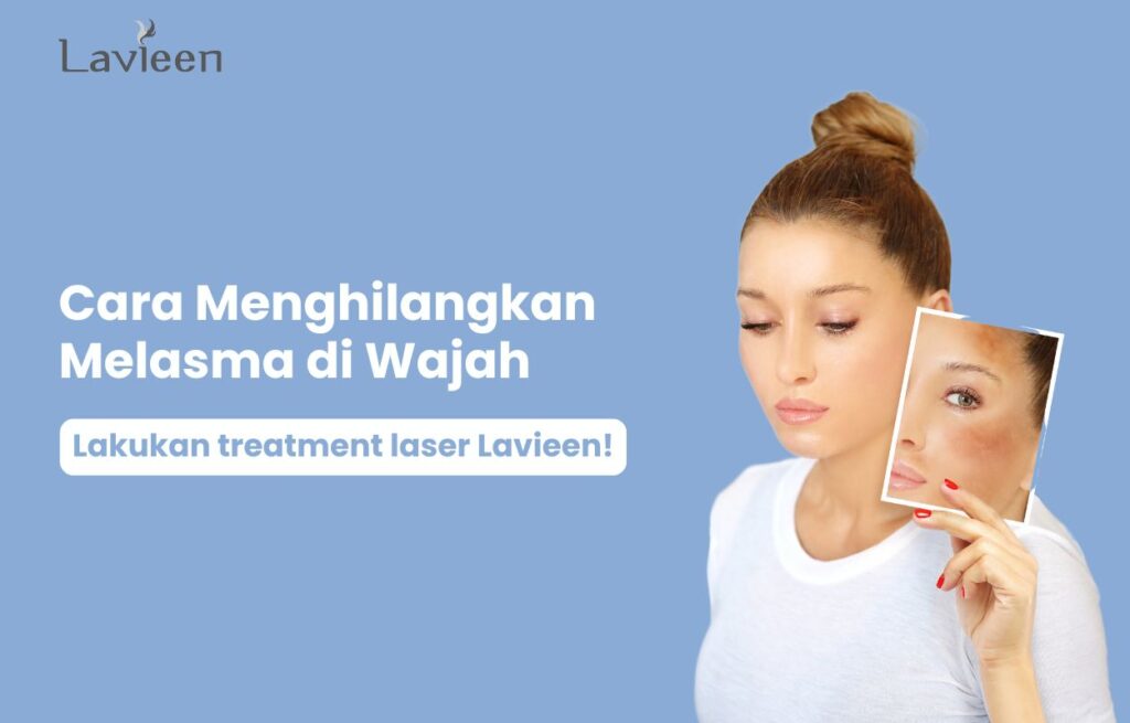 Cara menghilangkan melasma di wajah