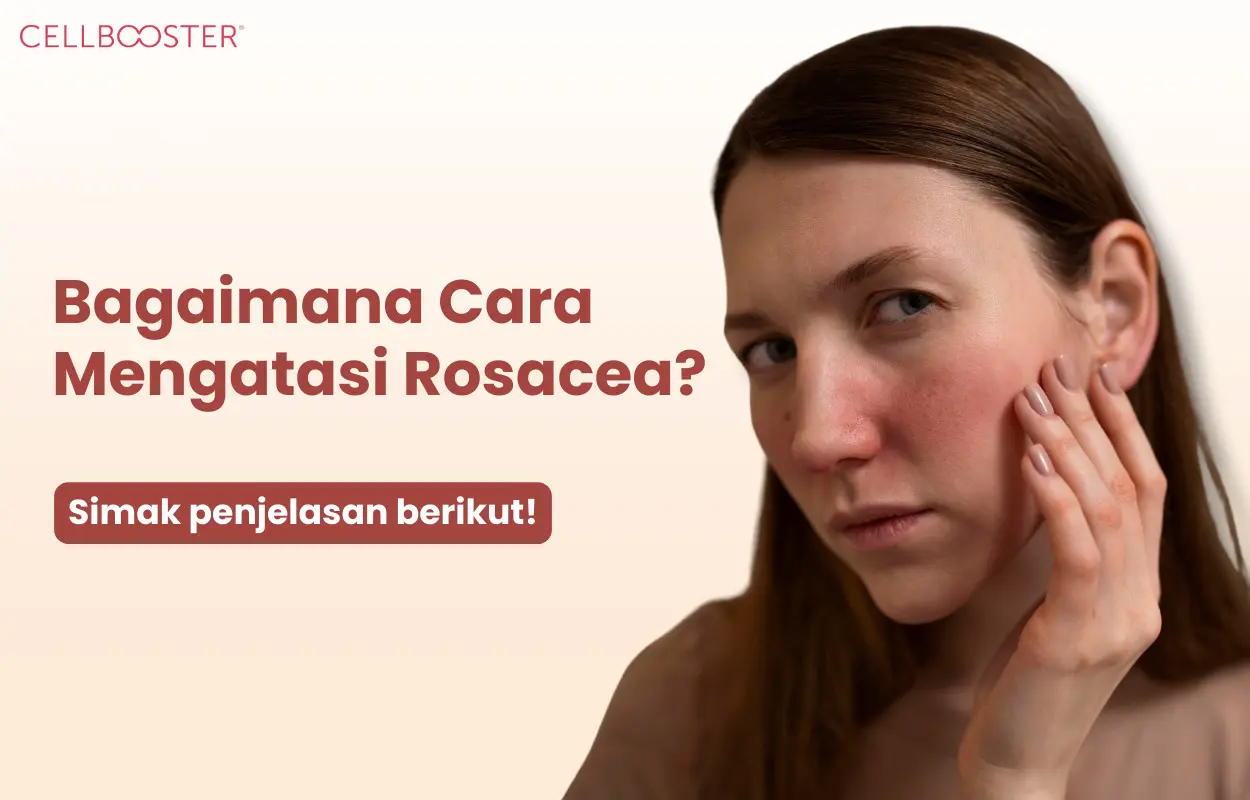 Rosacea