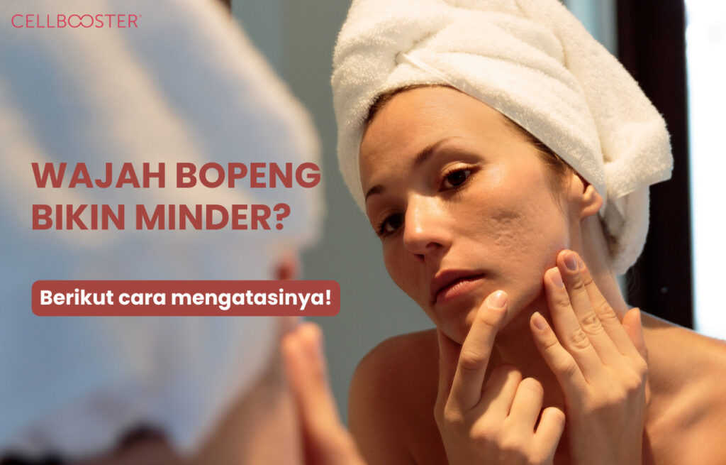 Tips Mengatasi Wajah Bopeng