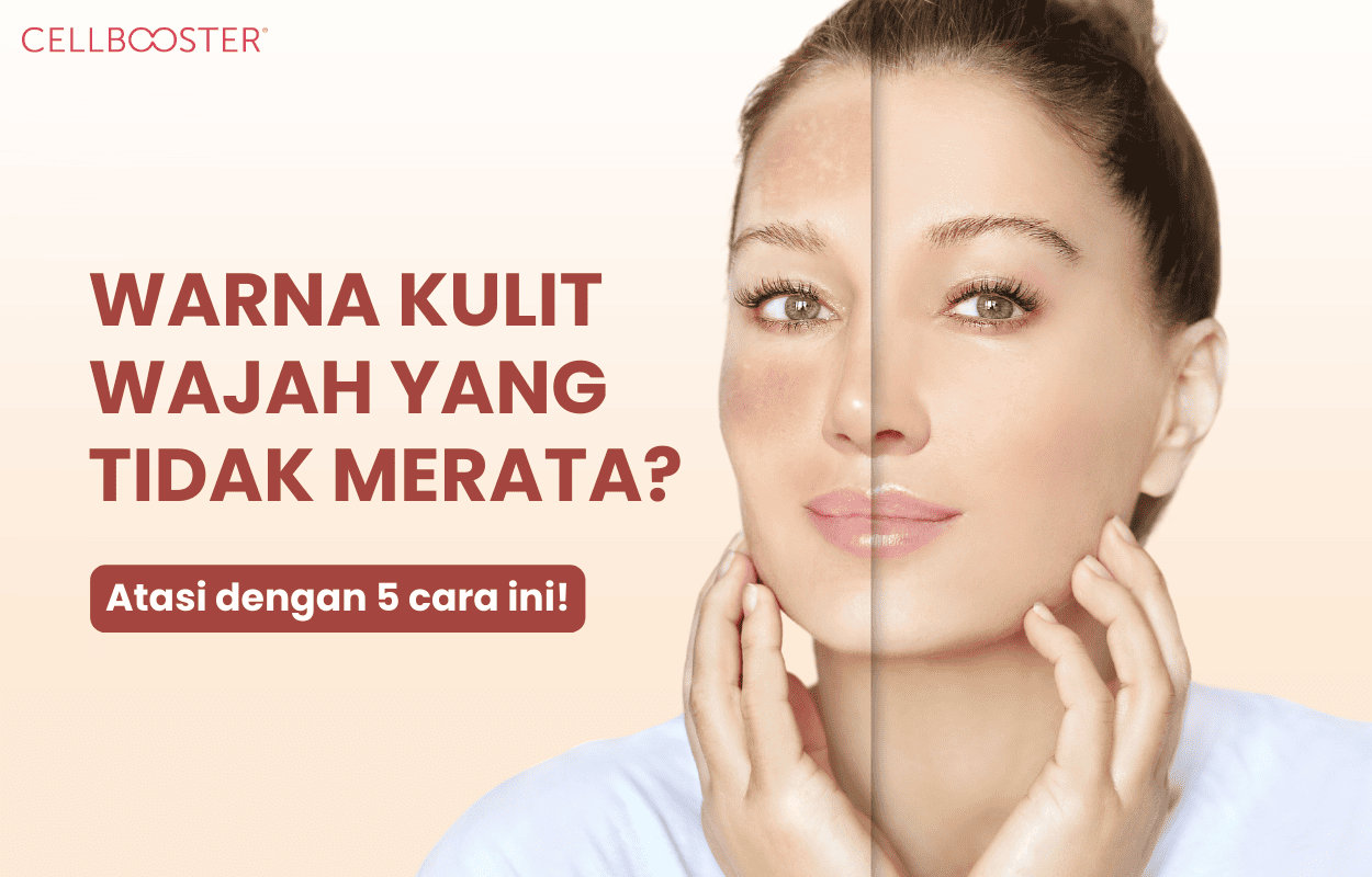 Cara Mengatasi Warna Kulit Wajah Tidak Merata