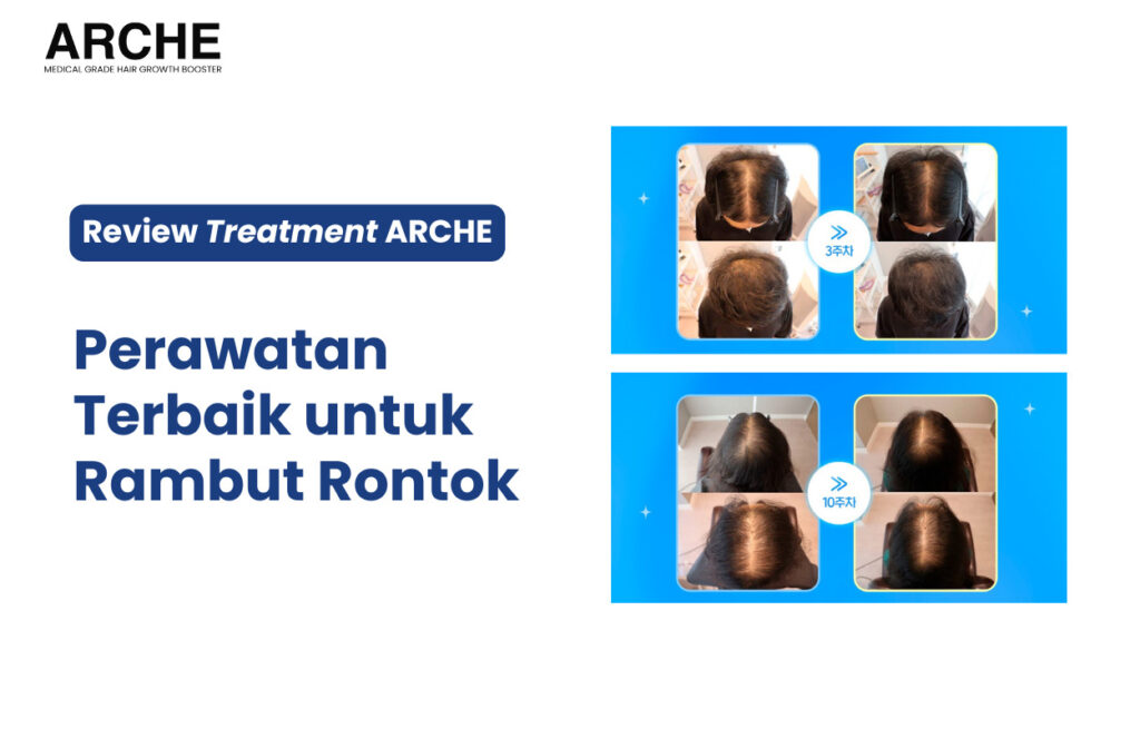 Rambut Kepala Rontok