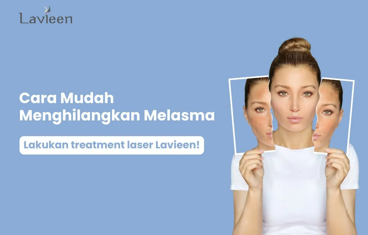 menghilangkan melasma