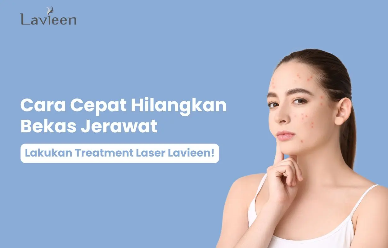 cara hilangkan bekas jerawat