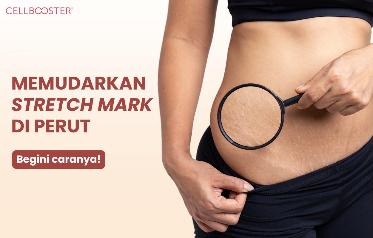 Cara Menghilangkan Stretch Mark di Perut