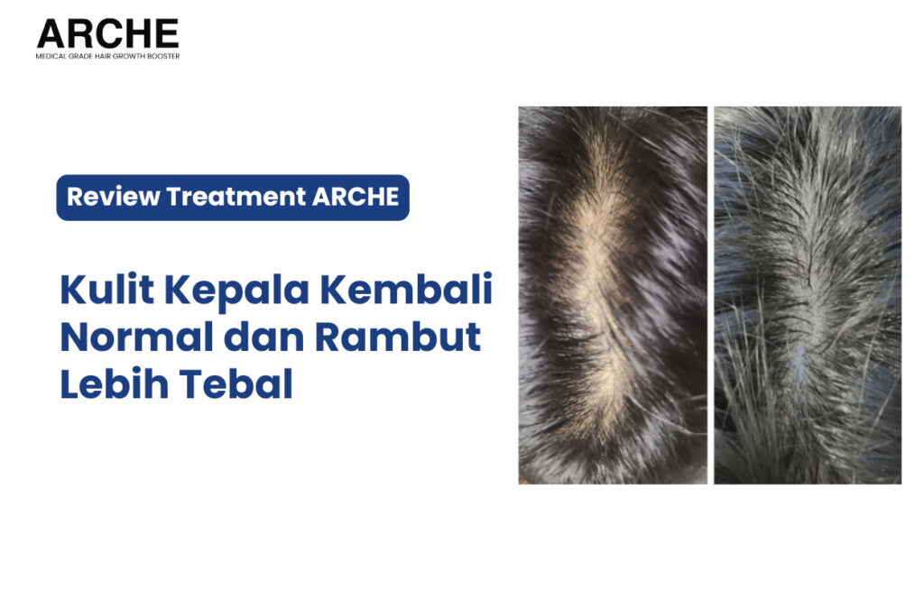 Kerontokan Rambut Setelah Melahirkan