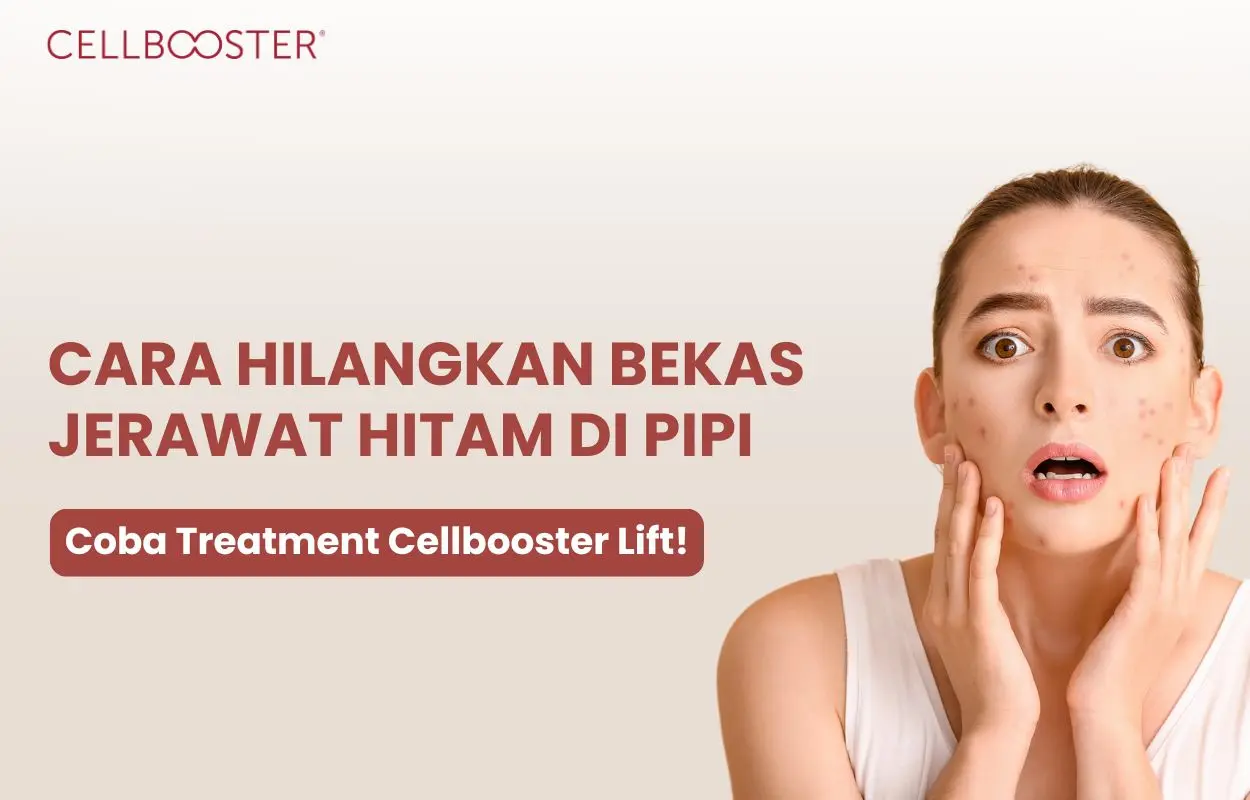 menghilangkan bekas jerawat hitam dengan cepat