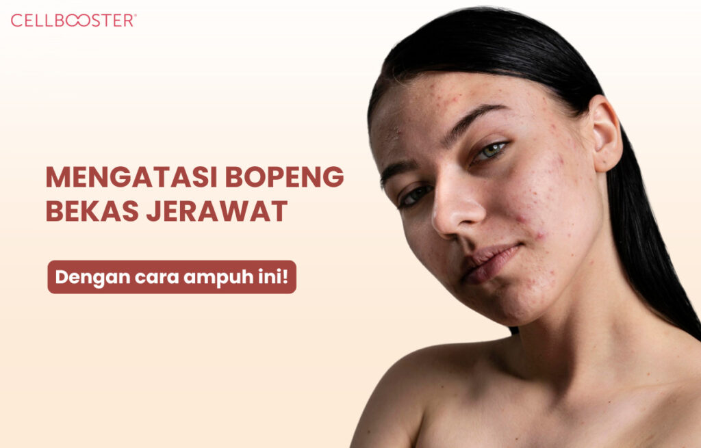 Cara Mengatasi Bopeng Bekas Jerawat