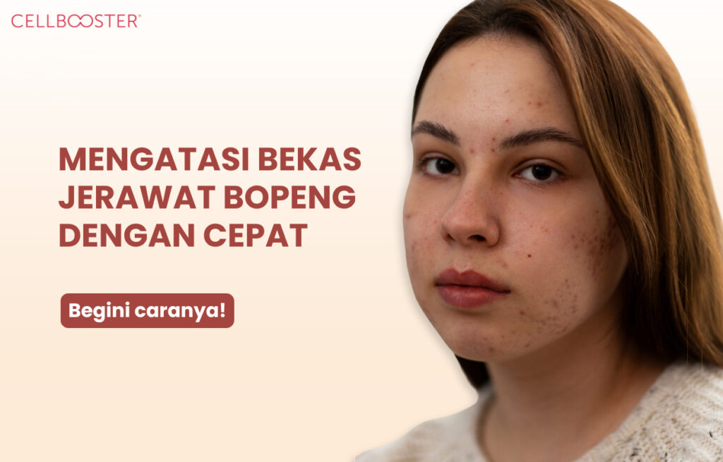Cara Mengatasi Bekas Jerawat Bopeng