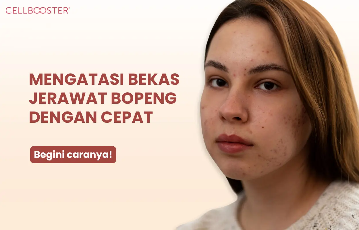 Cara Mengatasi Bekas Jerawat Bopeng