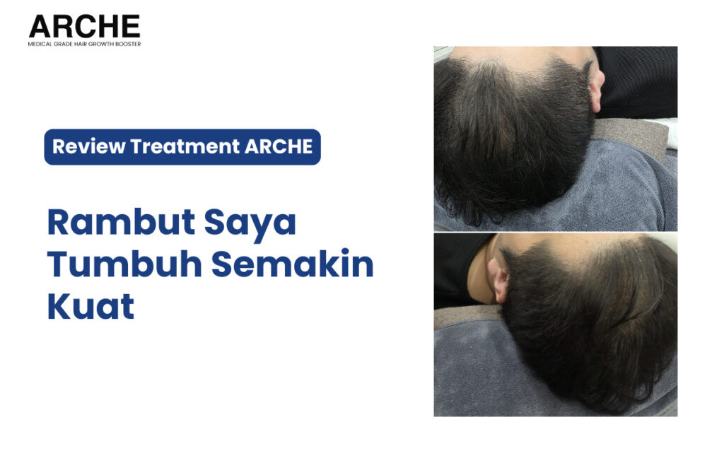Review Jujur: ARCHE efektif untuk Mengatasi Kebotakan pada Area Ubun-ubun Pria