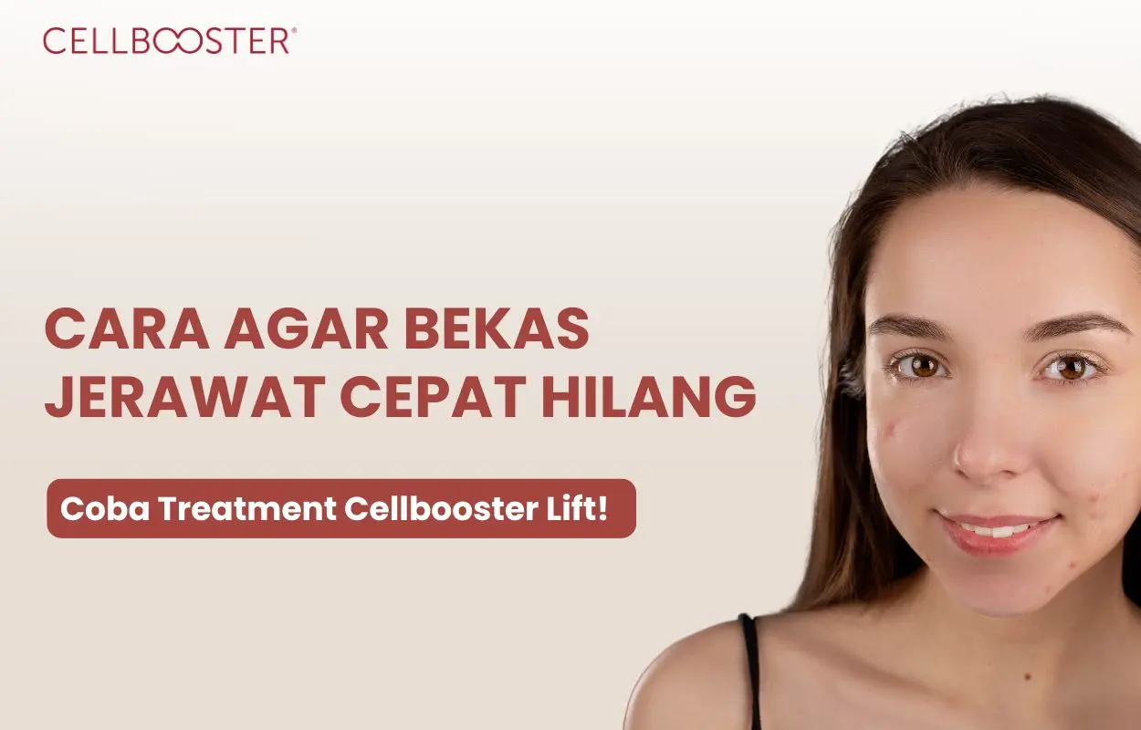 cara agar bekas jerawat cepat hilang