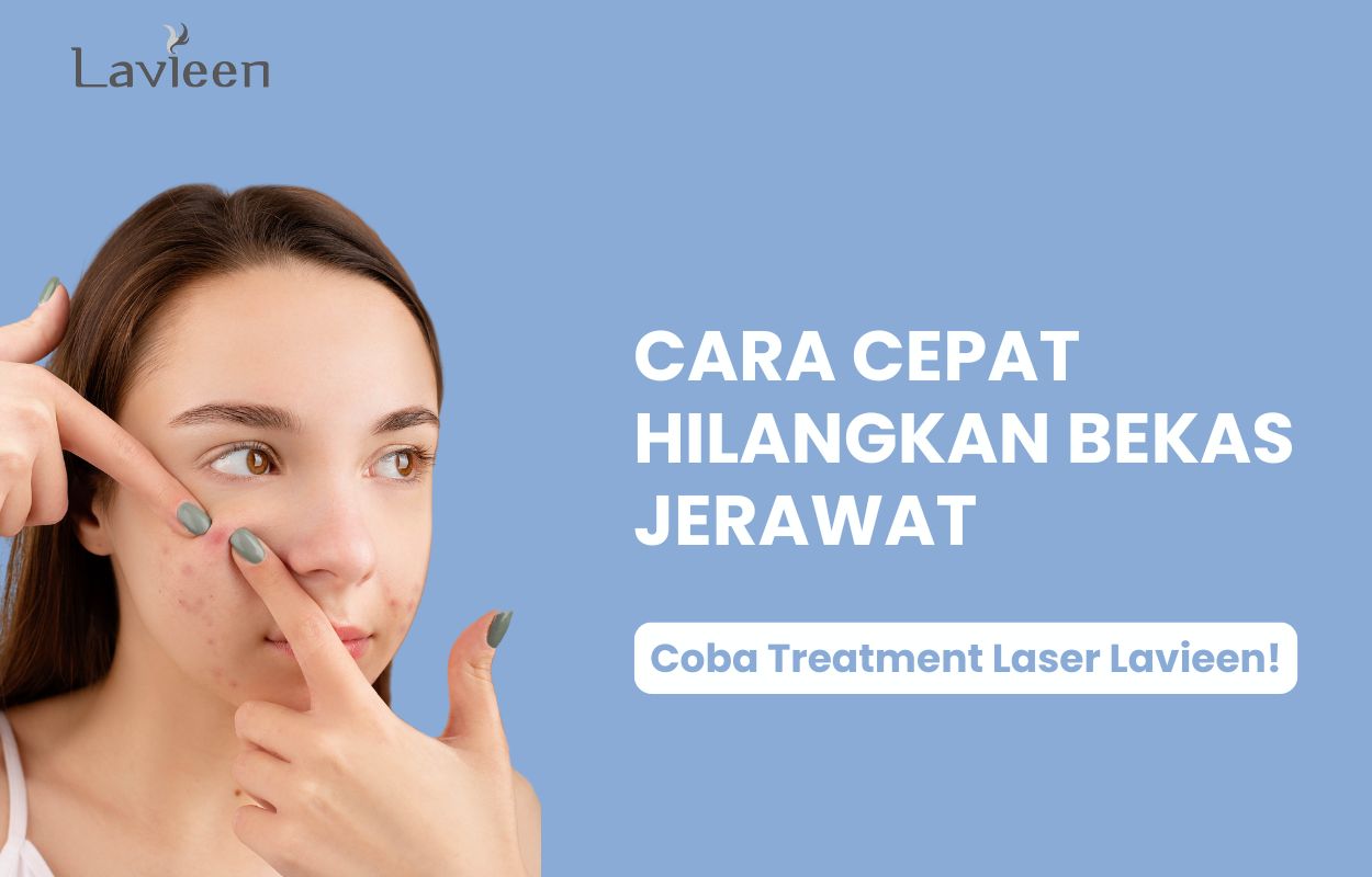 cara menghilangkan bekas jerawat dengan cepat