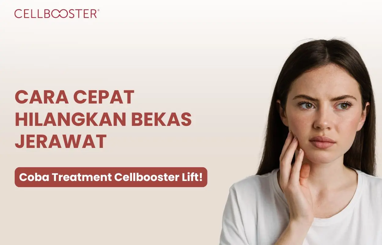 cara cepat hilangkan bekas jerawat