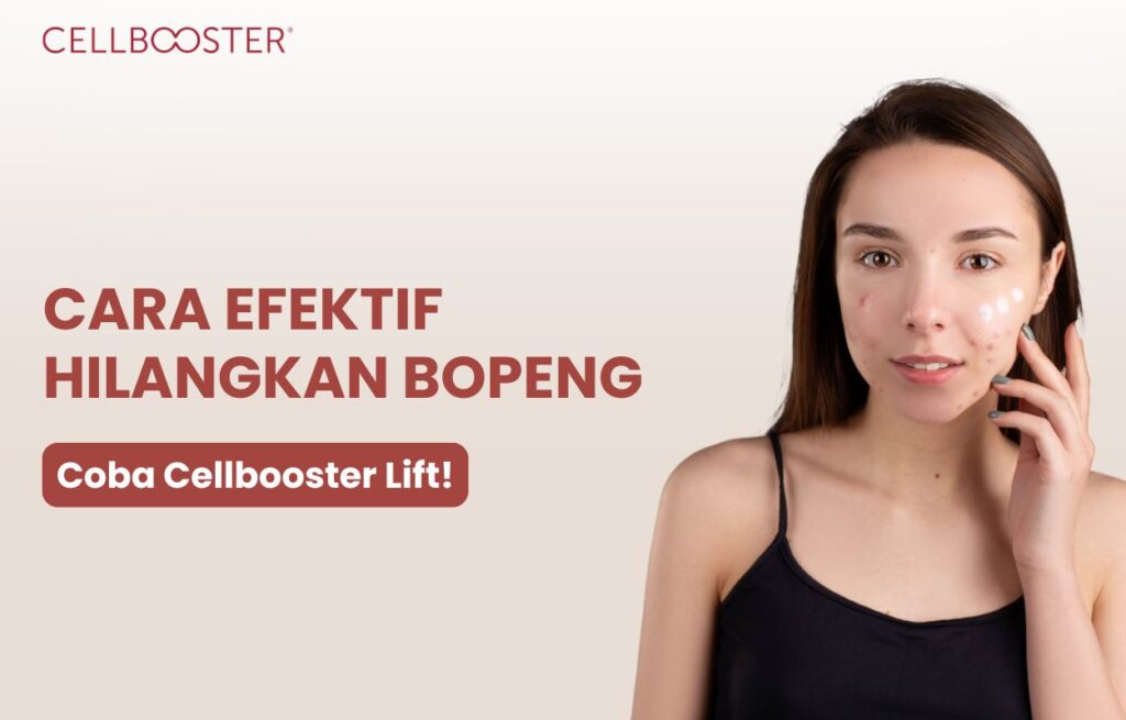 cara hilangkan bopeng bekas jerawat