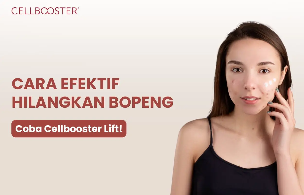 cara hilangkan bopeng bekas jerawat