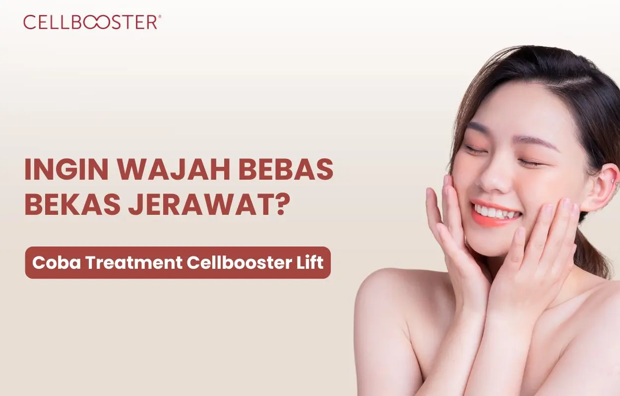 cara ngilangin bekas jerawat bopeng